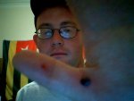 Blood Blister.jpg